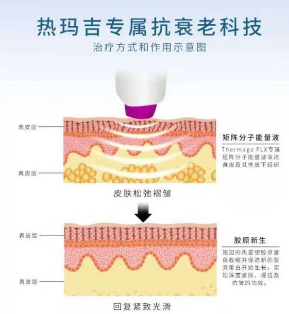 北京石榴美容醫(yī)院:熱瑪吉是不是射頻設(shè)備?