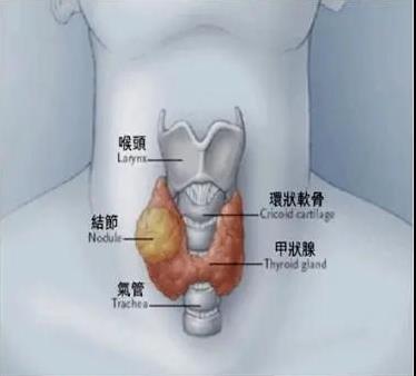 53歲阿姨查出甲狀腺癌,成都民生耳鼻喉為她成功實(shí)施手術(shù)