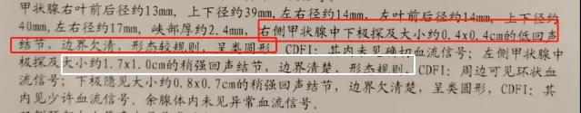 53歲阿姨查出甲狀腺癌,成都民生耳鼻喉為她成功實(shí)施手術(shù)