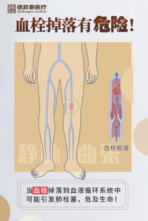 每天用曲康健,靜脈曲張恢復(fù)光滑,從此不再疼痛難受