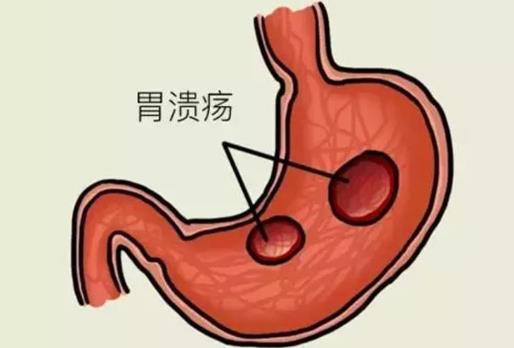 胃潰瘍的病因有哪些?胃潰瘍的癥狀有哪些