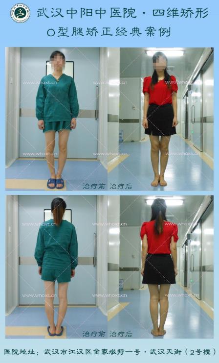 怎樣使X型腿變直?武漢中陽中醫(yī)醫(yī)院“四維矯形”技術(shù)無痕矯正