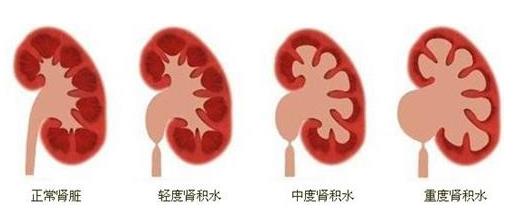云南結(jié)石病醫(yī)院腎結(jié)石患者:腎結(jié)石癥狀腰疼就像一把刀子來回絞動