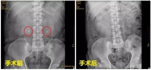 云南結(jié)石病醫(yī)院腎結(jié)石患者:腎結(jié)石癥狀腰疼就像一把刀子來回絞動