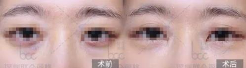 嗨體熊貓針憑什么撐起愛美客公司千億市值?