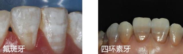 廣東省全民愛牙行動(dòng) 給大家講一下瓷貼面美學(xué)修復(fù)~