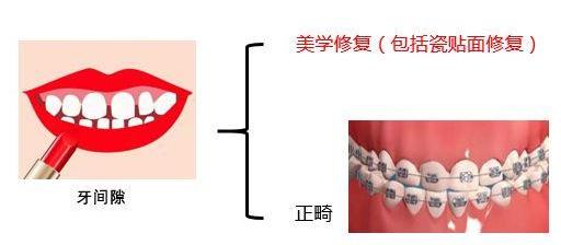 廣東省全民愛牙行動(dòng) 給大家講一下瓷貼面美學(xué)修復(fù)~
