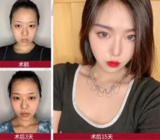 祛眼袋京典麗園不開刀靠譜嗎?專利技術(shù)加持