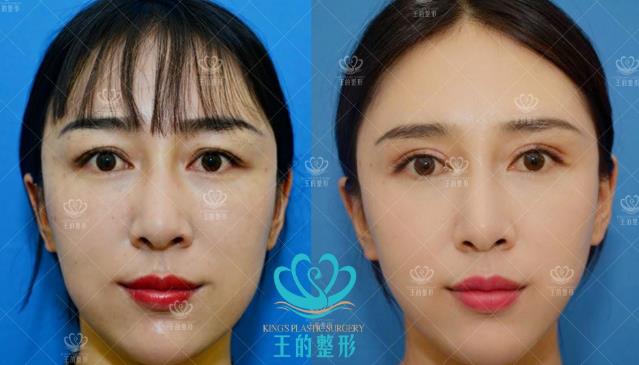 雙眼皮修復(fù)有多難?云南王海木院長(zhǎng)告訴你