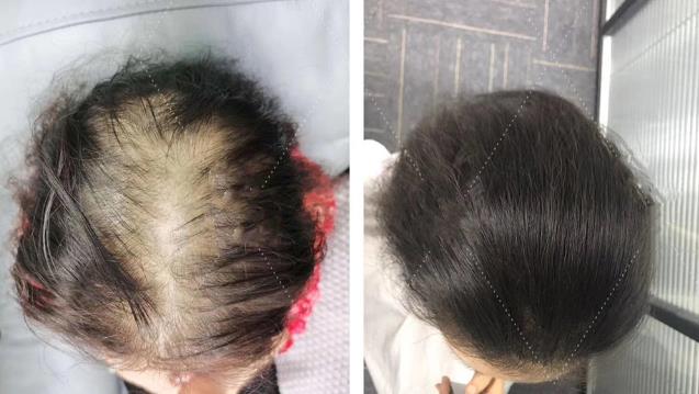 面對頭發(fā)稀疏怎么辦?日輕絲輕增發(fā)技術(shù)來幫忙