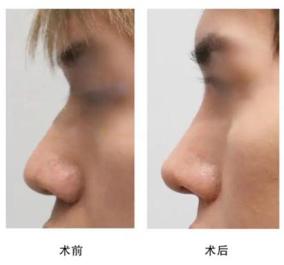 隆鼻再修復(fù) 高難度修復(fù) 美憬醫(yī)療修復(fù)基地 李炳澮教授