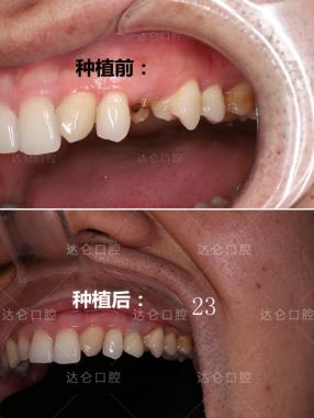 杭州種植牙十大高頻疑問,專業(yè)種植牙醫(yī)生一對一解答