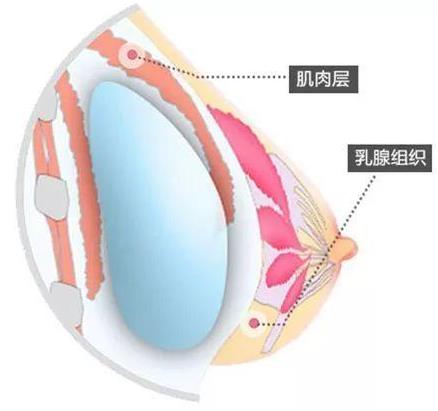 昆明想做假體隆胸,要怎么選擇?