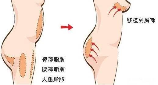 昆明想做假體隆胸,要怎么選擇?
