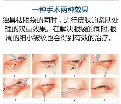 眼袋是怎么形成的,沈陽杏林整形做眼袋多少錢