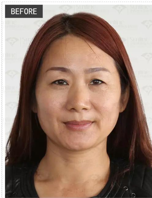 眼袋是怎么形成的,沈陽杏林整形做眼袋多少錢