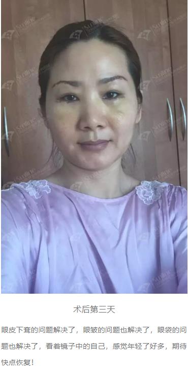 眼袋是怎么形成的,沈陽杏林整形做眼袋多少錢