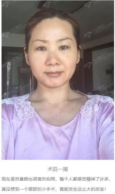 眼袋是怎么形成的,沈陽杏林整形做眼袋多少錢