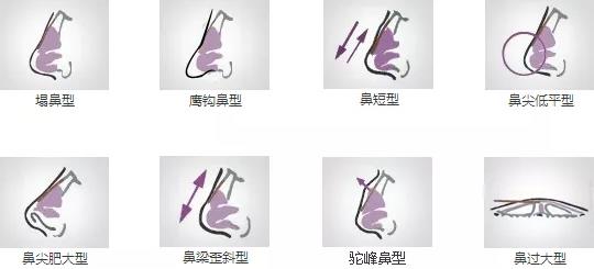 北京依一整形醫(yī)院武崇高醫(yī)生隆鼻好嗎 原生鼻綜合,秒變氣質(zhì)女神!