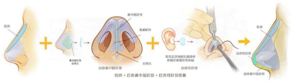 北京依一整形醫(yī)院武崇高醫(yī)生隆鼻好嗎 原生鼻綜合,秒變氣質(zhì)女神!