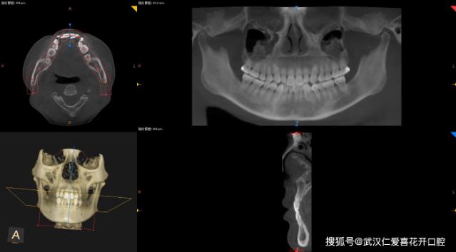武漢仁愛口腔醫(yī)師告訴你正畸前為什么要拍片