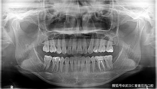 武漢仁愛口腔醫(yī)師告訴你正畸前為什么要拍片