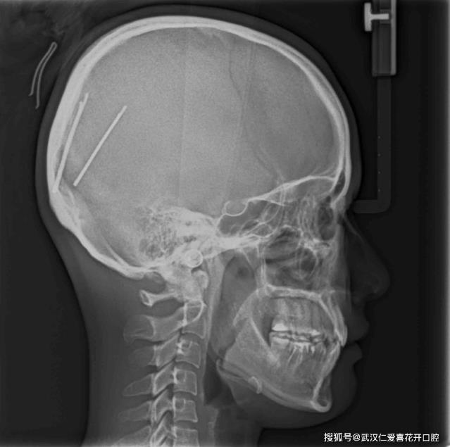武漢仁愛口腔醫(yī)師告訴你正畸前為什么要拍片