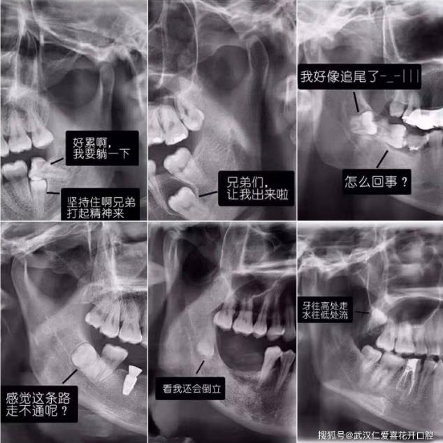 武漢仁愛(ài)口腔真實(shí)案例告訴你——為什么智齒要趁早拔