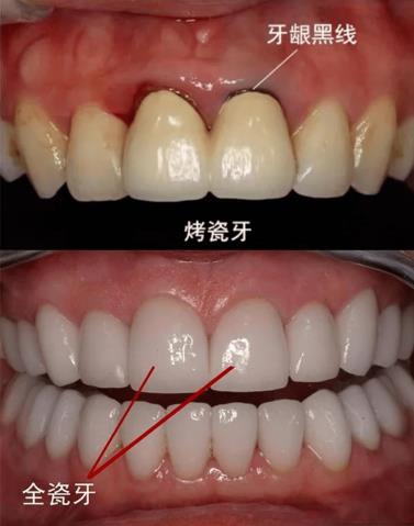 武漢仁愛口腔全瓷牙效果如何?能用多久?有什么優(yōu)勢(shì)?