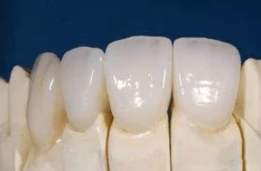 武漢仁愛口腔全瓷牙效果如何?能用多久?有什么優(yōu)勢(shì)?