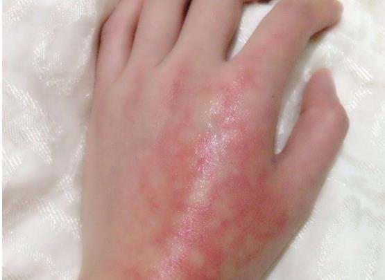 被水燙傷第一時(shí)間怎么處理?手上燙紅了會(huì)不會(huì)留疤
