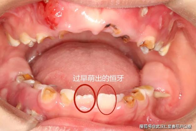 武漢仁愛口腔案例表示:“猛性齲”未及時治療,4歲男童一口牙幾乎爛光