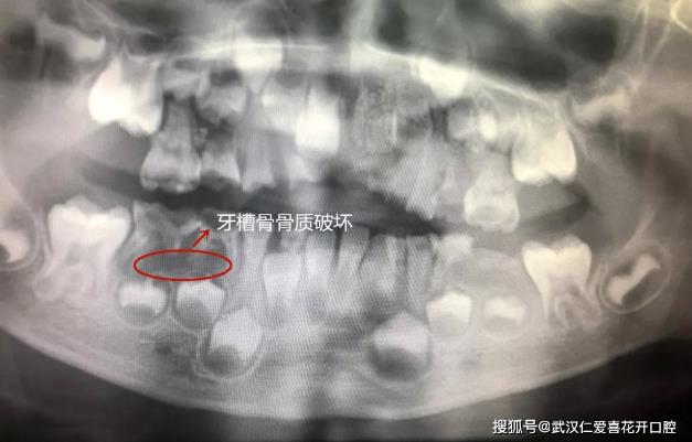武漢仁愛口腔案例表示:“猛性齲”未及時治療,4歲男童一口牙幾乎爛光