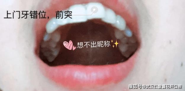 武漢仁愛口腔:小姐姐歷經(jīng)3次矯正終于成功,整牙避坑干貨必看!