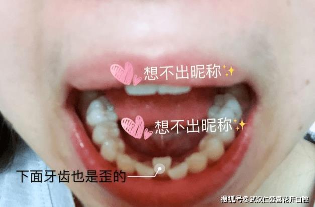 武漢仁愛口腔:小姐姐歷經(jīng)3次矯正終于成功,整牙避坑干貨必看!