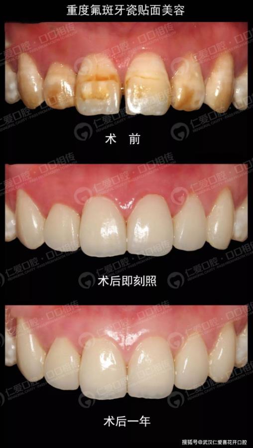 武漢仁愛口腔牙齒貼面好不好,來看這位90后小哥哥的貼面效果吧