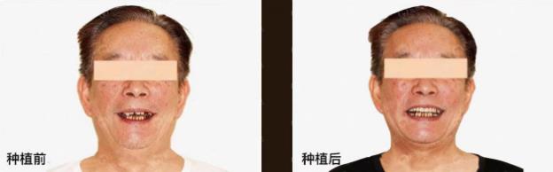 武漢仁愛口腔:半口即刻種植2小時,當天種當天用!
