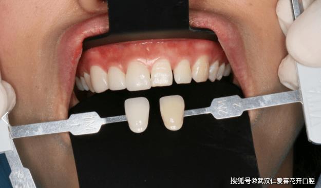 武漢仁愛口腔牙齒貼面好不好,來看這位90后小哥哥的貼面效果吧