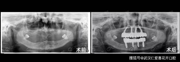 武漢仁愛口腔種植案例60歲王阿姨長“新牙”,多虧了“數(shù)字化即刻”種植!