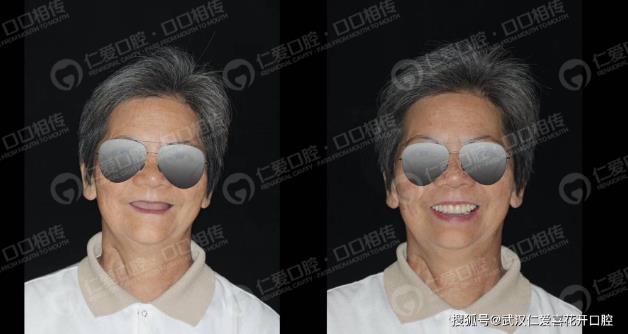 武漢仁愛口腔種植案例60歲王阿姨長“新牙”,多虧了“數(shù)字化即刻”種植!