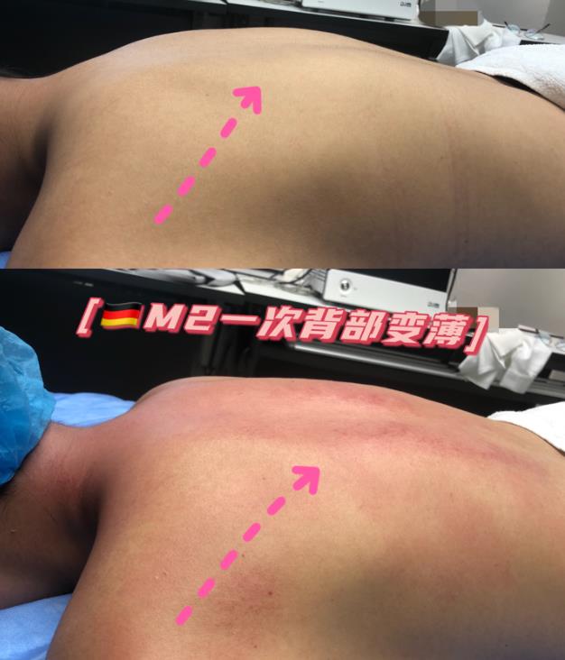 DJM-M2熱力緹效果好不好?由內(nèi)而外喚醒你的身體