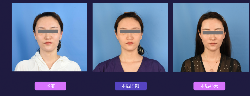 寧波藝星整形醫(yī)院:7D黃金超聲炮,深層抗衰,一次抵三次熱瑪吉!
