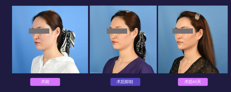 寧波藝星整形醫(yī)院:7D黃金超聲炮,深層抗衰,一次抵三次熱瑪吉!