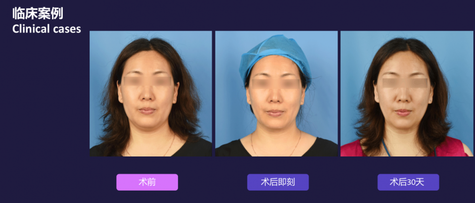 寧波藝星整形醫(yī)院:7D黃金超聲炮,深層抗衰,一次抵三次熱瑪吉!