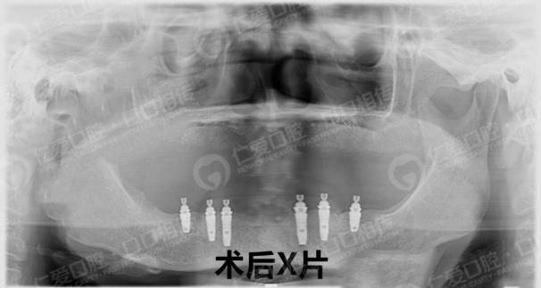 武漢仁愛口腔為一位58歲大叔尋求口福的神奇之旅!