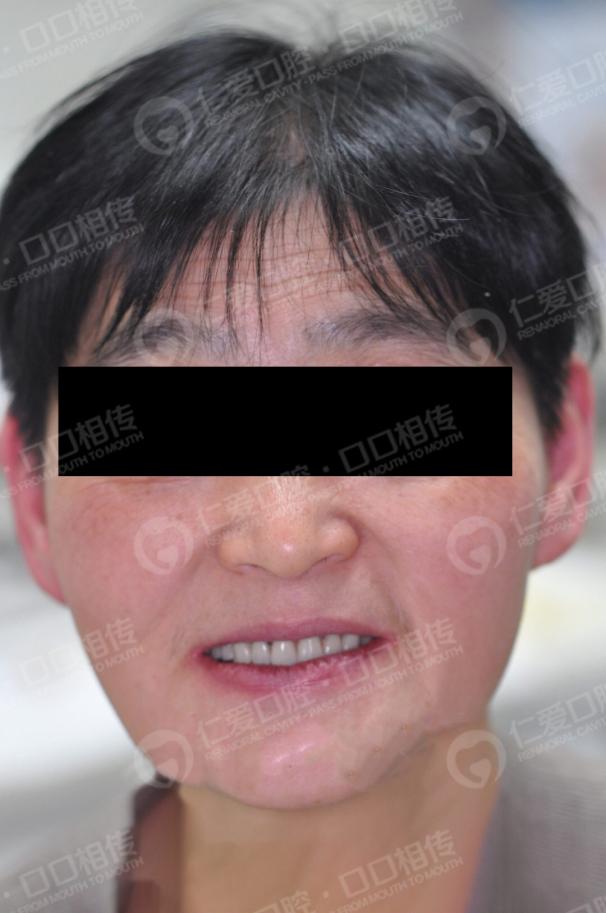 武漢仁愛口腔為一位58歲大叔尋求口福的神奇之旅!