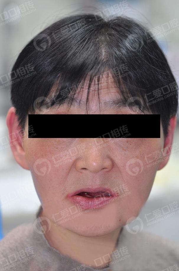 武漢仁愛口腔為一位58歲大叔尋求口福的神奇之旅!