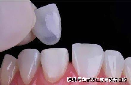 武漢仁愛(ài)口腔 牙齒貼面修復(fù),讓笑容從“齒”綻放!