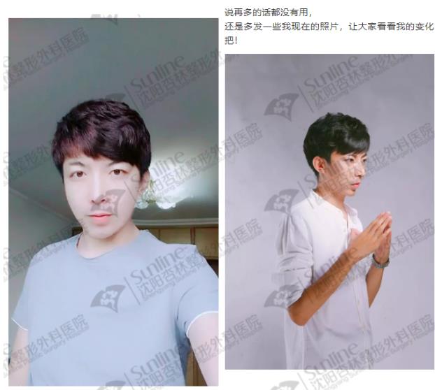 沈陽杏林整形外科醫(yī)院上下頜凸嘴矯正價格表,沈陽哪能削骨