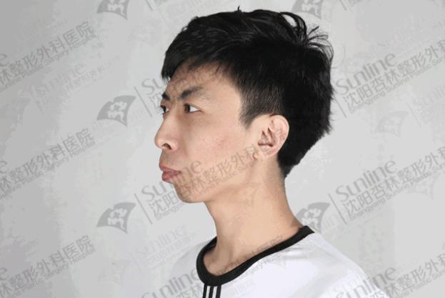 沈陽杏林整形外科醫(yī)院上下頜凸嘴矯正價格表,沈陽哪能削骨